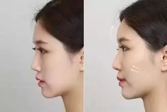 陈乔恩苹果肌 (陈乔恩苹果肌的照片)