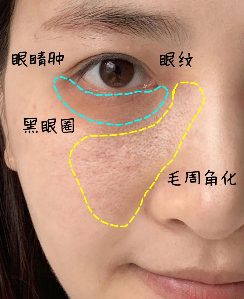 祛痘痘的产品价格多少合适,平价祛痘痘10元以下