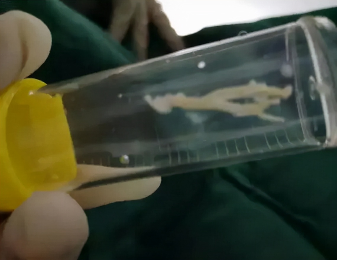 肺炎支气管镜一般费用多少,肺炎不好反复发烧