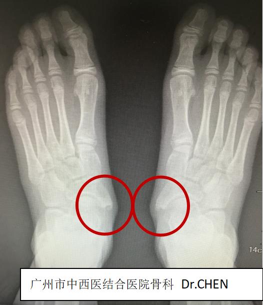 成人足副舟骨痛最佳解决方案,后天性扁平足导致副舟骨疼痛