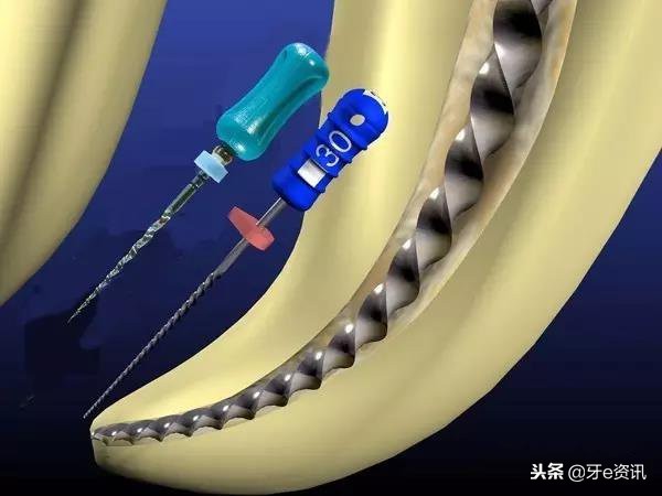 补牙和根管治疗有哪些区别,补牙和根管治疗有何不同