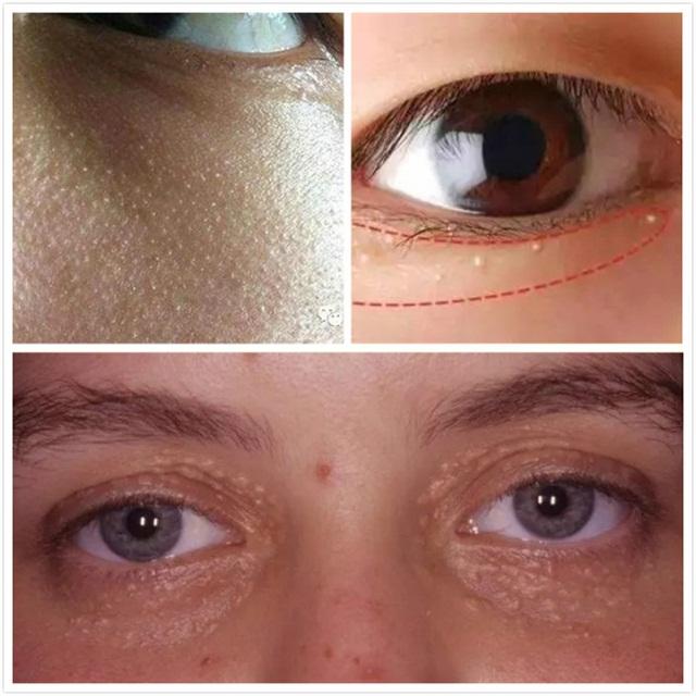 脂肪粒白头怎么去,脂肪粒去除小妙招皮肤