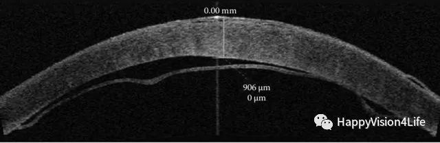 洞察超乳术后角膜的水肿