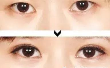 男生割眼皮术后,男性割眼皮后1-7天恢复图