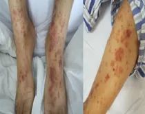 过敏性紫癜腹痛休克,过敏性紫癜剧烈腹痛