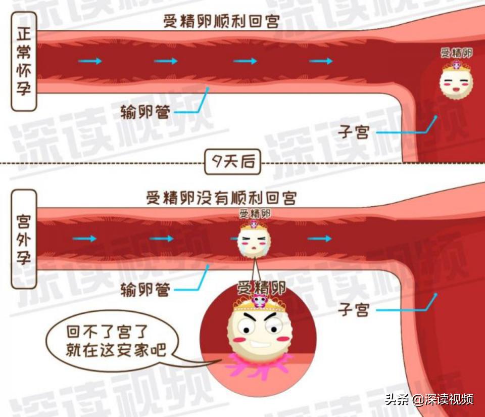 宫外孕一直流血怎么回事,宫外孕是怎么回事呢