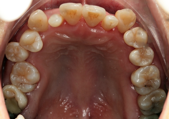 牙周炎为什么会引起牙齿松动,牙龈肿胀牙齿松动的原因牙周炎