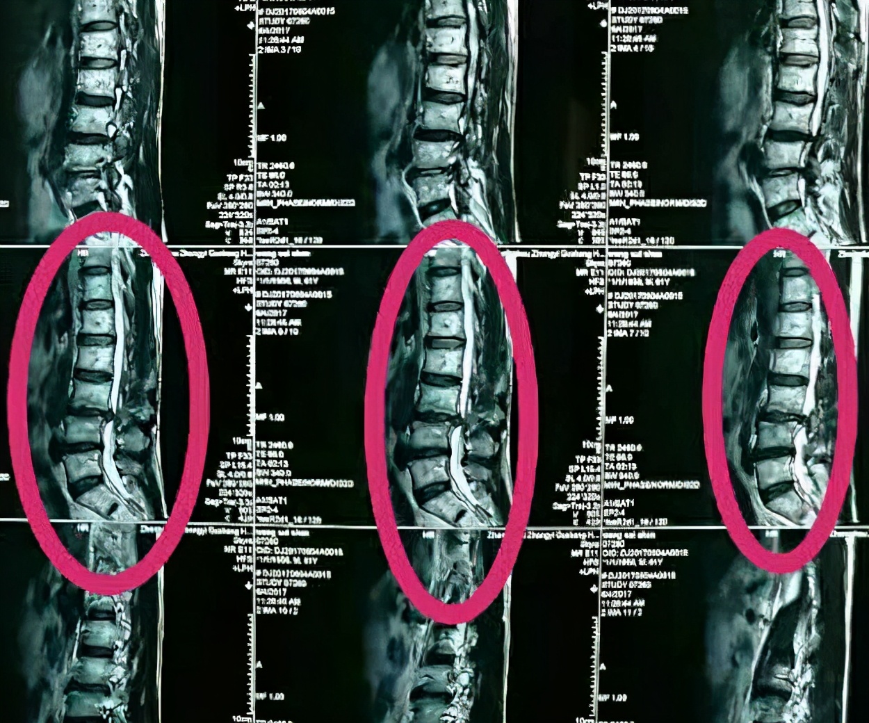牵引动作治疗腰间盘突出,牵引法治疗腰间盘突出操作