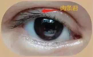 龚忠华整形,龚忠华双眼皮手术后多久恢复