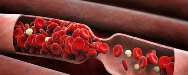 血液粘稠的症状有哪些,血液粘稠的人有什么症状