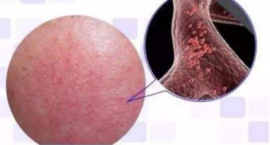 红血丝是脸皮薄还是厚,潮红型红血丝怎么去修复