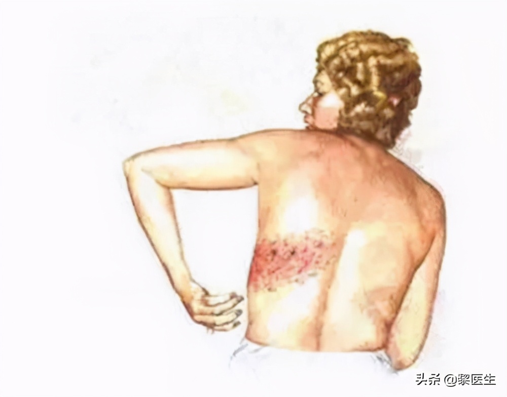 缠腰蛇的疱疹能弄烂吗,蛇缠腰带状疱疹引起神经痛严重吗