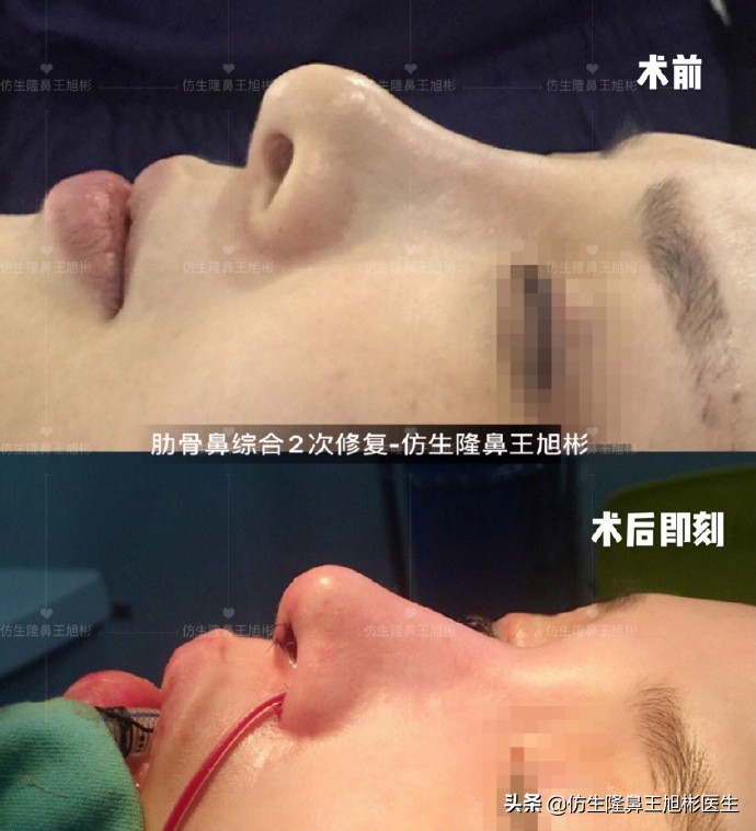 隆鼻的鼻翼怎么修复,隆鼻后多久可以做鼻翼缘矫正