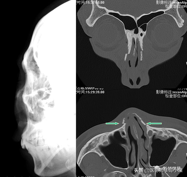 「鼻骨彩图」鼻骨CT解剖及骨折影像学诊断