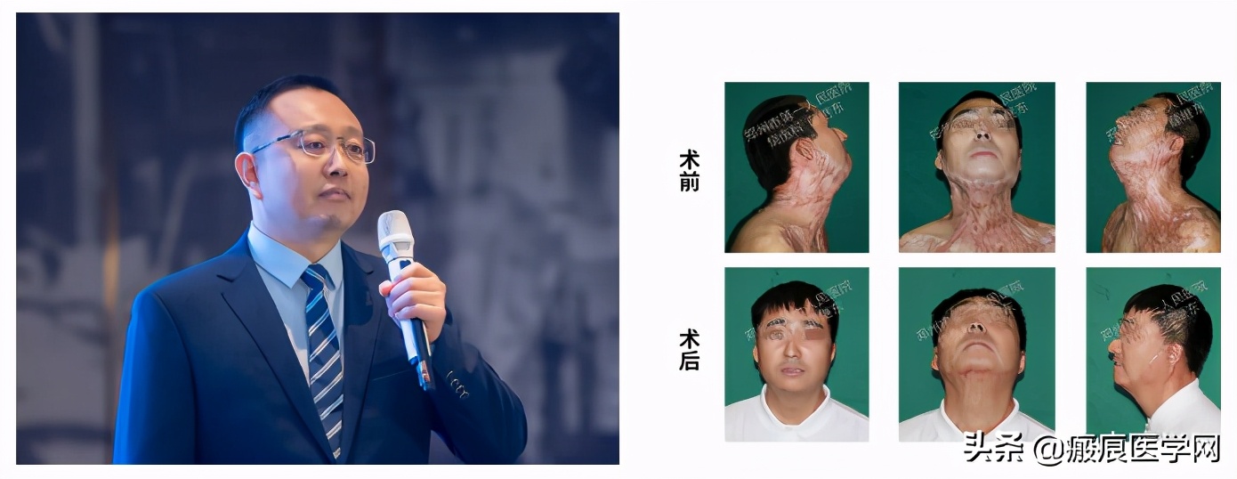 鐦㈢棔妗堜緥,鐤ょ棔娌荤枟鎴愬姛妗堜緥