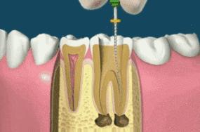 根管治疗后牙齿劈裂怎么办最好,戴冠后牙会不会劈裂