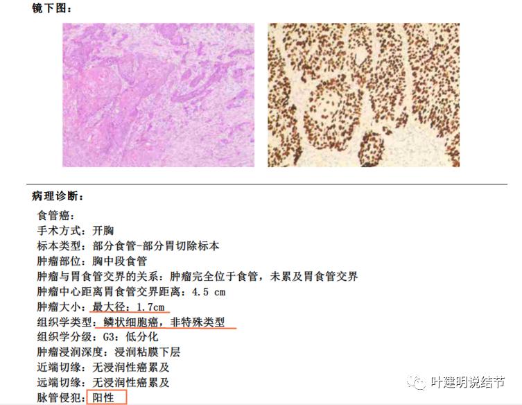 同时发现结肠癌和肺癌怎么处理,同时患结肠癌和直肠癌怎么办