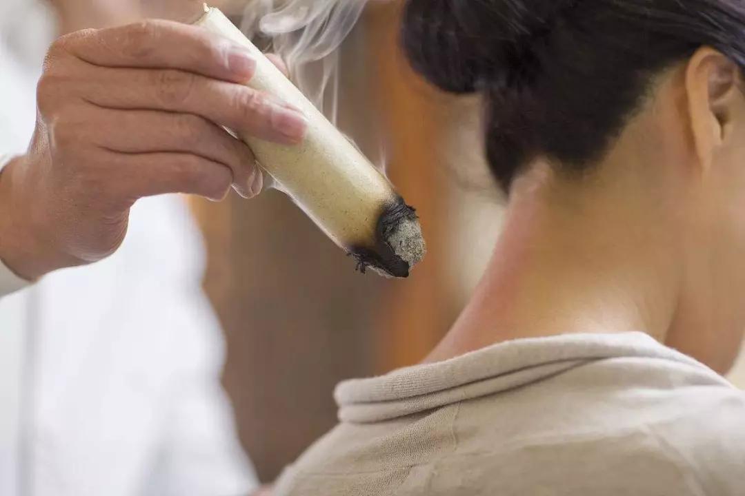 艾灸和拔罐哪个祛湿气效果好一些,三伏祛湿最有效的方法艾灸