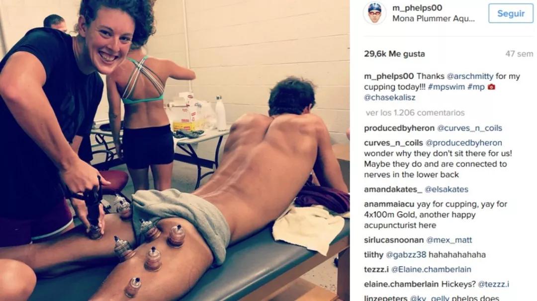 神秘“东方力量”再现奥运会!原来中医拔罐有这么多好处