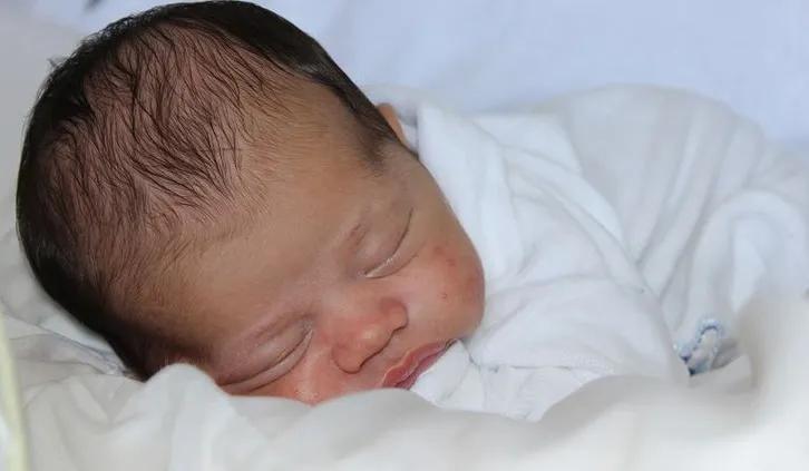 孩子得了湿疹应如何治疗与管理,父母都有湿疹怎么避免孩子湿疹