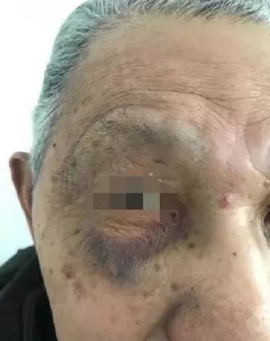 85岁老人惨遭保姆多次毒打,85岁老人遭保姆多次毒打