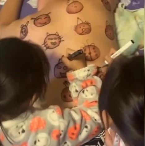 爸爸拔火罐后续,爸爸拔火罐后背留下印记