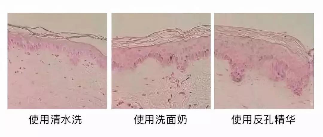 有黑头和没黑头有什么区别,没有长过黑头却长黑头怎么办