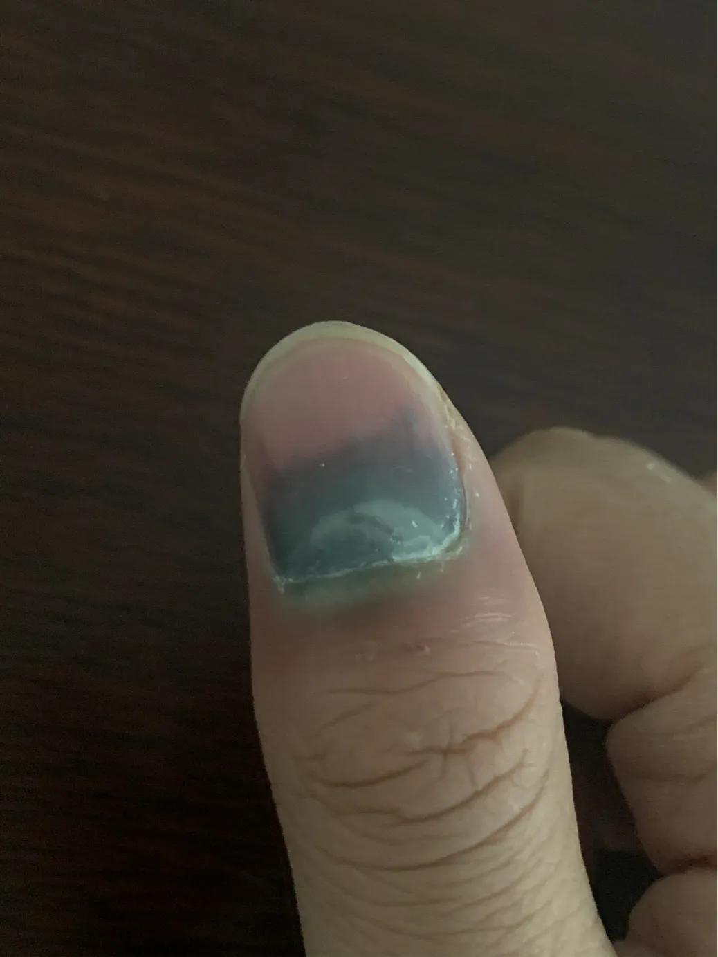 手指被夹出淤血该怎么办,手指被门夹淤血疼到睡不着