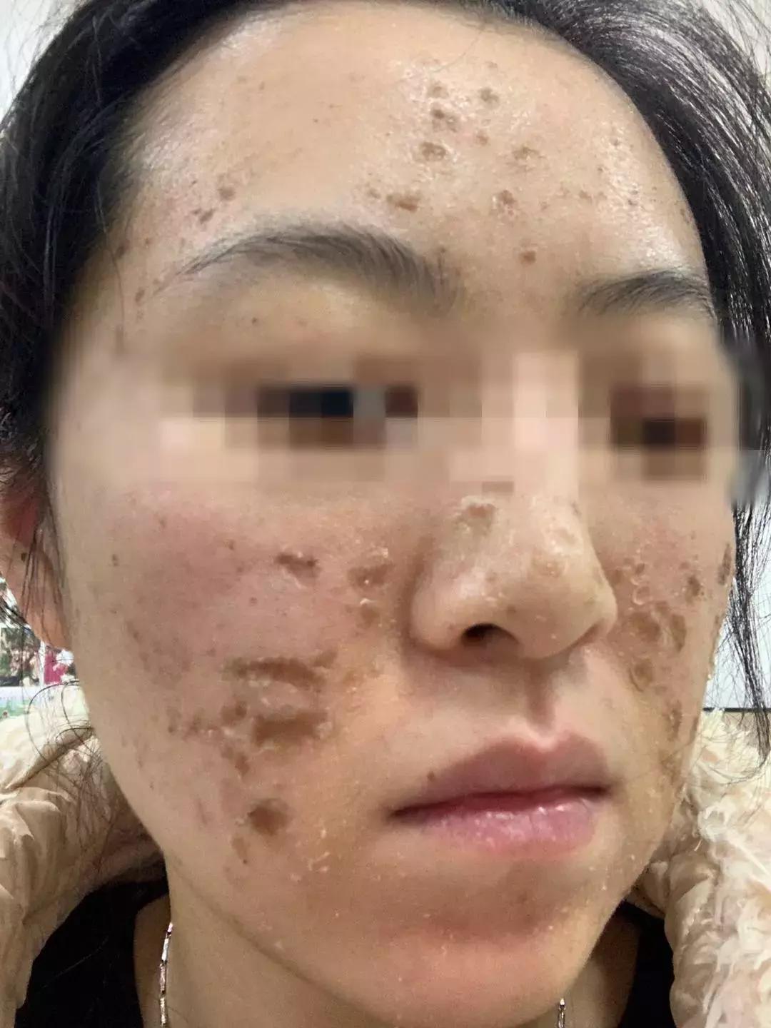 一次美容后她脸烂了!无锡这位女士在整形医院经历了什么……