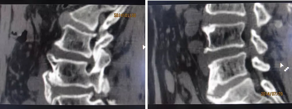 颈椎腰椎疾病ct及mri诊断,腰椎ct可以发现肠部病变吗