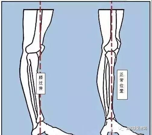 偏瘫绳带疗法视频讲解教程全集,绳带疗法在偏瘫康复的应用
