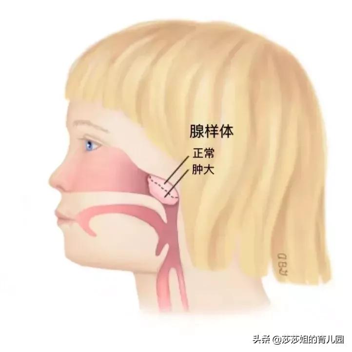 张嘴呼吸一定是腺样体肥大吗,张口呼吸一定会腺样体面容吗