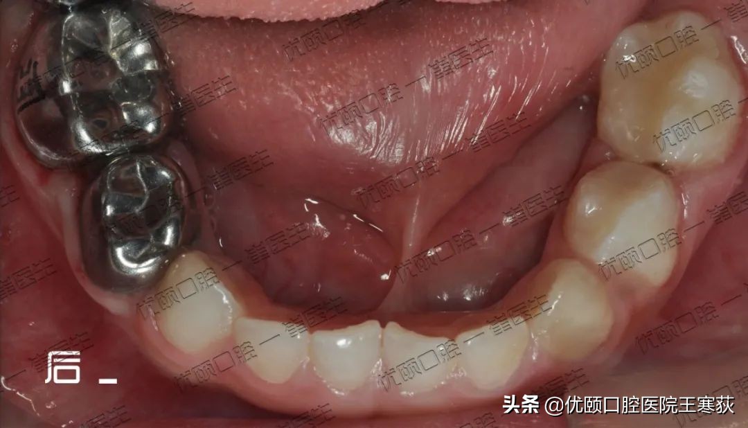 儿童全麻治疗过程,三岁宝宝根管治疗全麻有危害吗