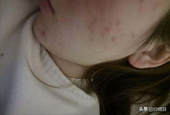 红肿硬块痘痘没有脓怎么快速消退,红肿痘痘不疼了但是还是有包