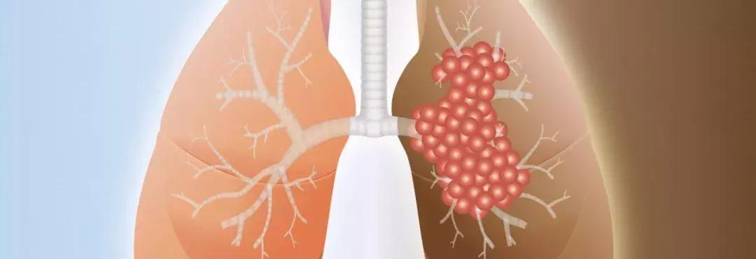 肺癌5年复发化疗方案,肺癌四期成功案例