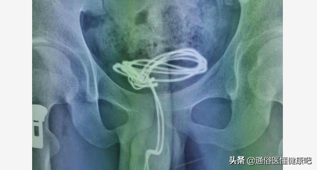 少年血尿是什么原因引起的,少年血尿是怎么回事