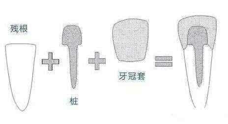 一位良心牙医的14条忠告,一位良心牙医的忠告全瓷牙
