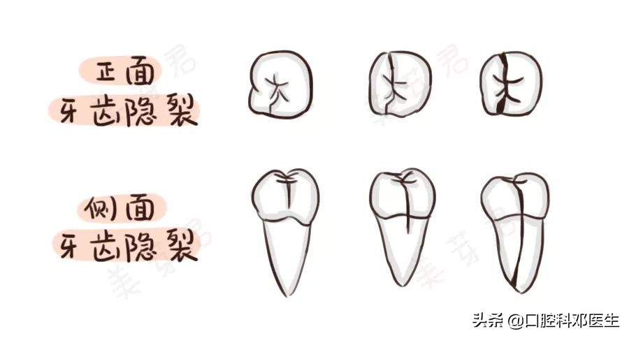 疫情后牙齿怎么修复好一点,肺炎期间能治牙吗