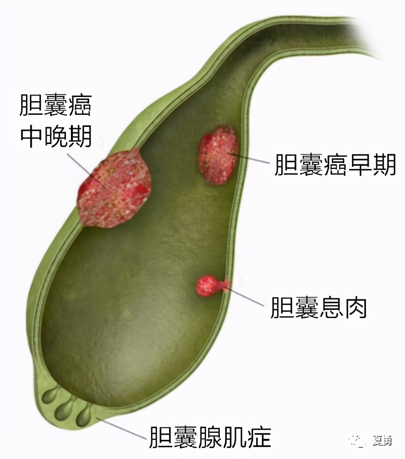 癌症王中王活下来的人,癌症王中王是指什么病