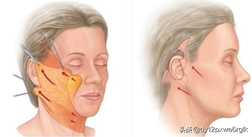 拉皮除皱明显的优点,拉皮除皱手术真的有效吗