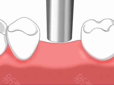 种植牙和烤瓷牙究竟有哪些区别？为什么都说种植牙好？
