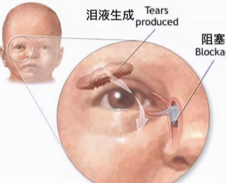 小孩儿眼屎黄多还咳嗽喝什么药,小孩黄眼屎多是什么原因引起的