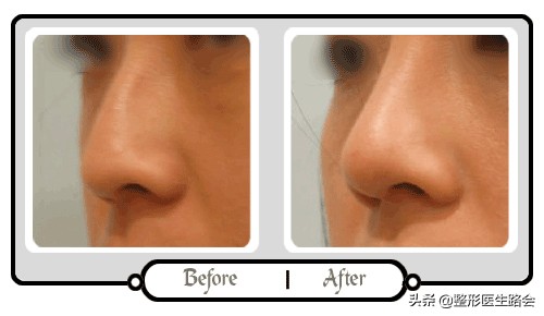 玻尿酸注射隆鼻可以热敷吗,玻尿酸注射鼻子有什么危害