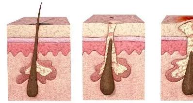 脱发后长出新头发绒毛怎么整理,脱发后发际线长出细小绒毛