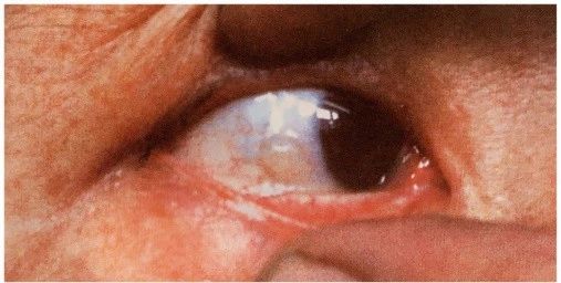 眼睛起了大水泡,我眼睛里面长了一个水泡