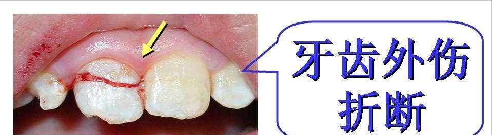 孩子摔一跤,小孩门牙摔断最好的方法怎么处理