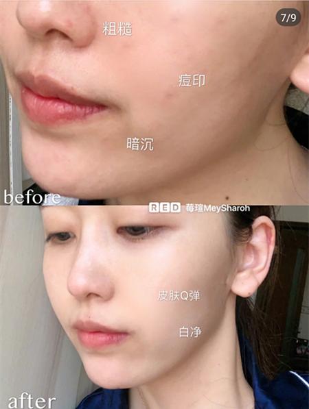 痘痘熟了之后如何正确处理,痘痘过后的脸怎么恢复