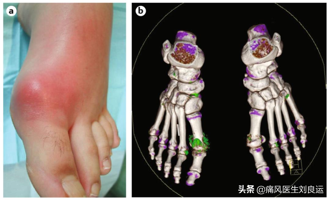 高尿酸没有症状到底要不要吃药,尿酸偏高怎么让尿酸下去