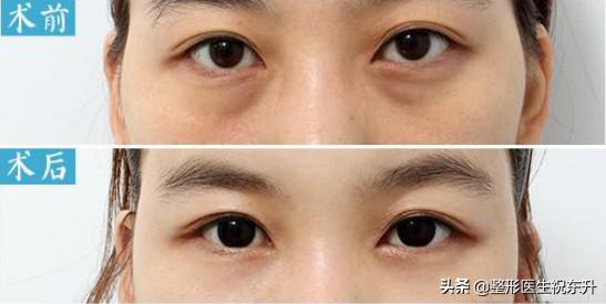 下眼皮下垂松弛可以打针吗,下眼皮睁不开是怎么回事