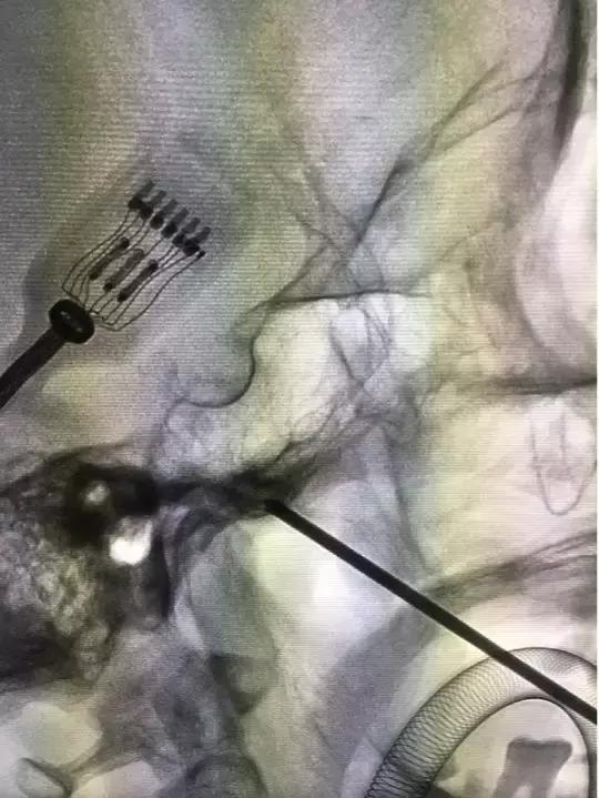 痛得拔光一排牙！解决炸裂“天下第一痛”一根套管针显乾坤
